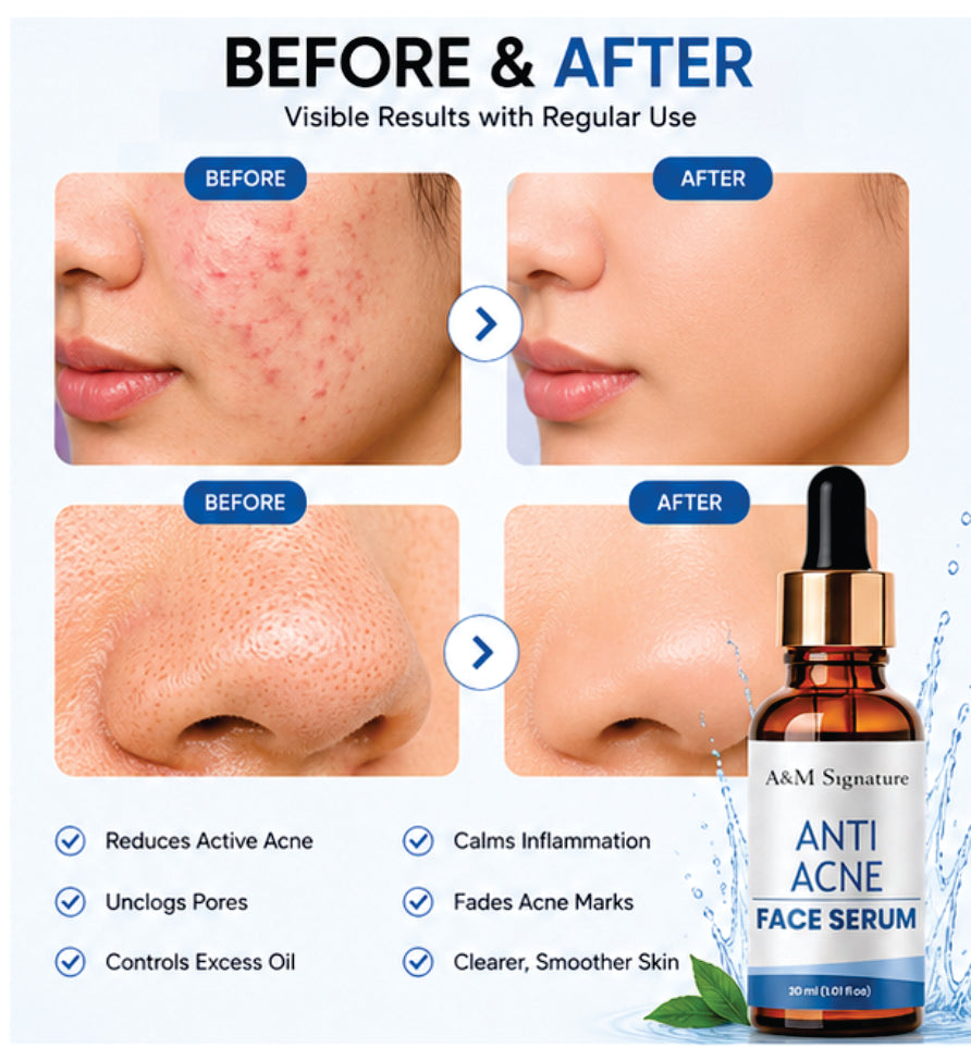 A&M Signature Anti Acne Face Serum for Clear Skin, Oil Control & Blemish Reduction, Lightweight Daily Serum for Acne-Prone Skin, Helps Reduce Pimples & Improves Skin Texture, 30 ml
