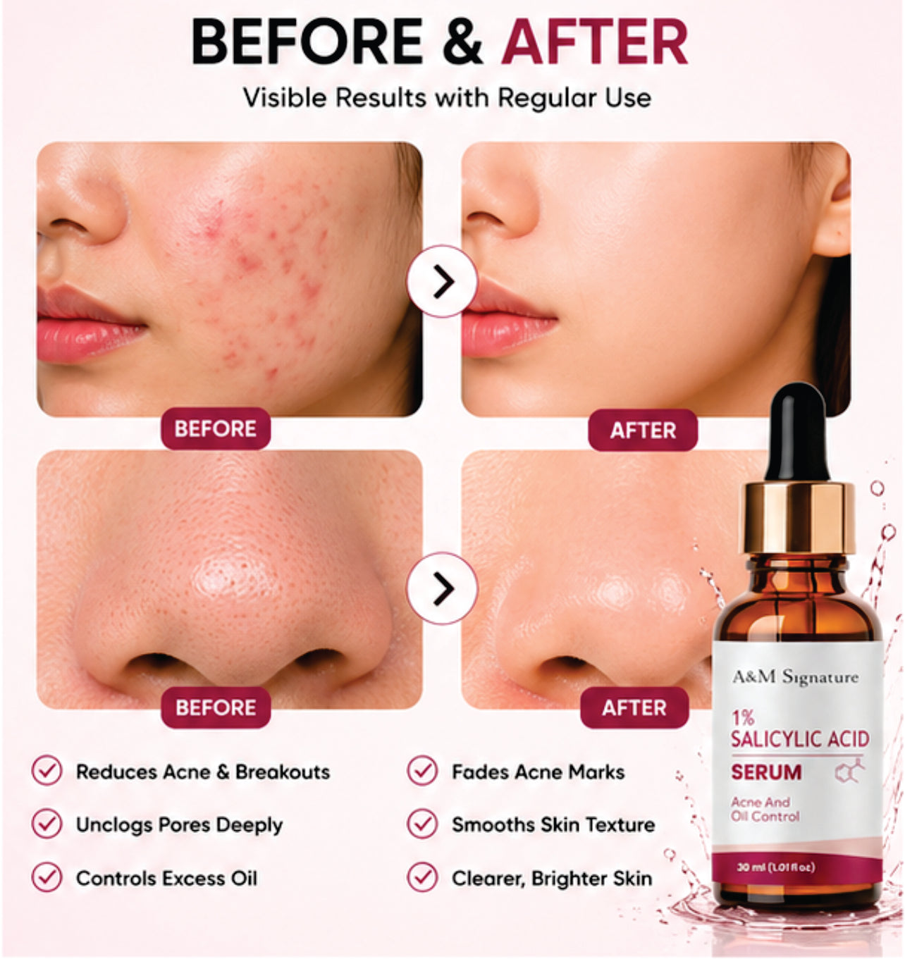 A&M Signature 1% Salicylic Acid Serum for Acne & Oil Control, BHA Exfoliating Face Serum for Clear Skin, Unclogs Pores & Reduces Breakouts, Lightweight Formula for Oily & Acne-Prone Skin, 30 ml