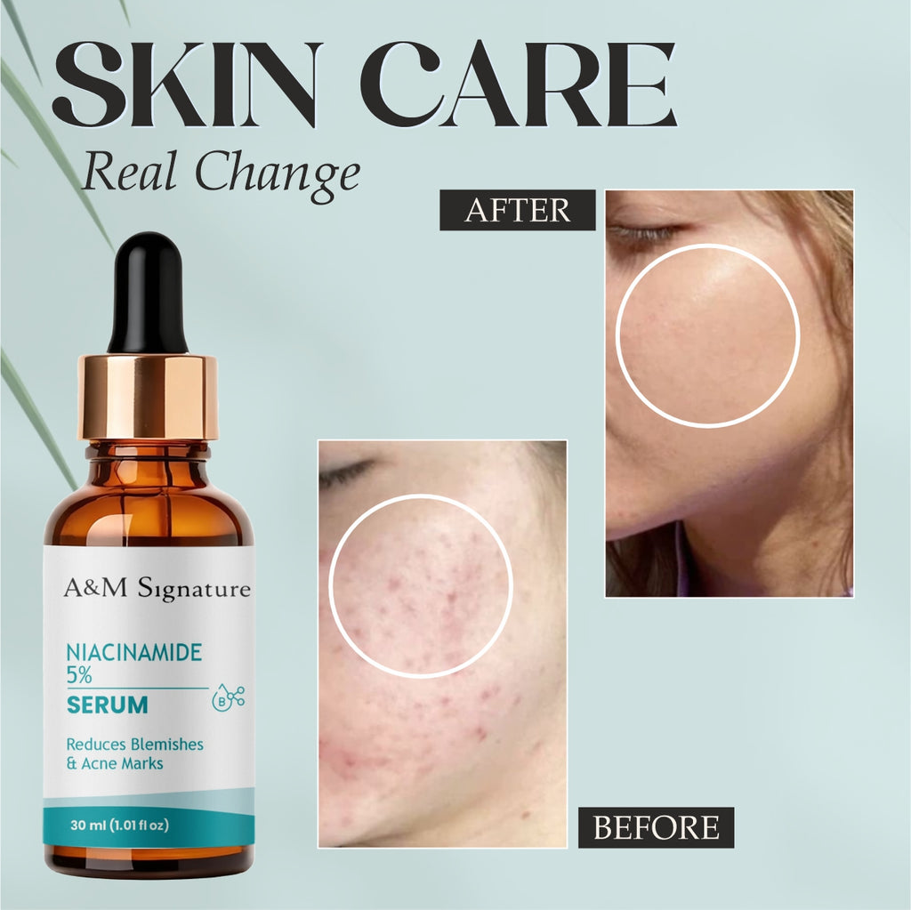 A&M Signature Niacinamide Serum for Acne Marks & Blemishes – Oil Control, Pore Minimizing & Brightening Face Serum for Clear, Smooth & Even-Toned Skin
